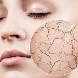 Dehydration Solution