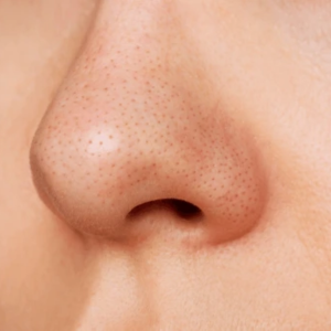 Blackheads & Whiteheads care