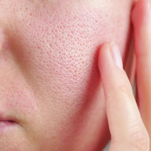 Large Pores/ Scars Solution