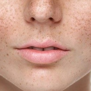Pigmentation/ Melasma Solution